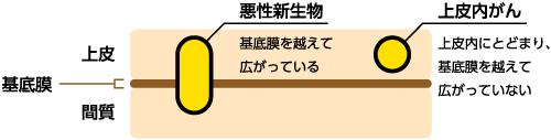 子宮頸部の場合のイメージ図